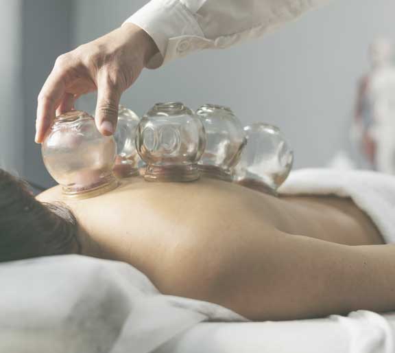 cupping-therapy-west-palm-beach